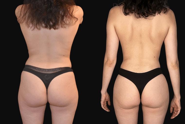 Ariel Ourian, MD bbl result โ Beverly Hills, CA