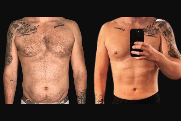Ariel Ourian, MD liposuction result — Beverly Hills, CA