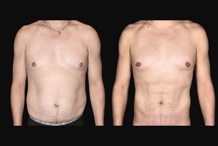 Ariel Ourian, MD liposuction result โ Beverly Hills, CA
