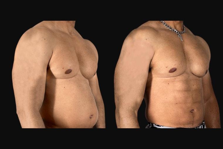 Ariel Ourian, MD liposuction result — Beverly Hills, CA