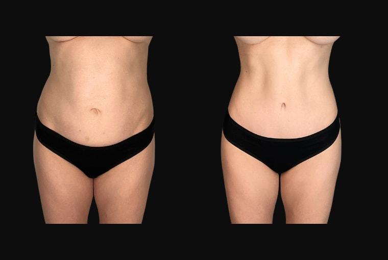 Ariel Ourian, MD tummy tuck result — Beverly Hills, CA