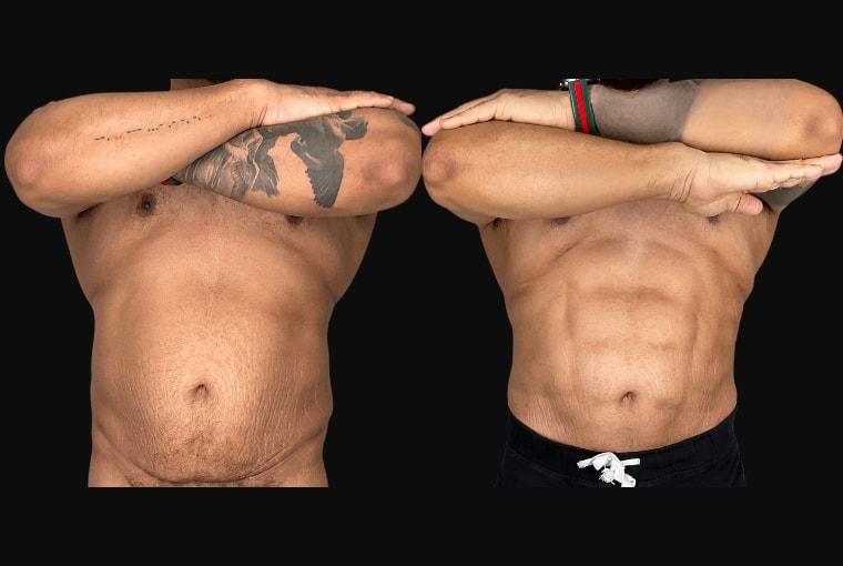 Ariel Ourian, MD liposuction result — Beverly Hills, CA