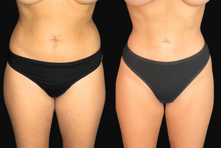 Ariel Ourian, MD liposuction result — Beverly Hills, CA