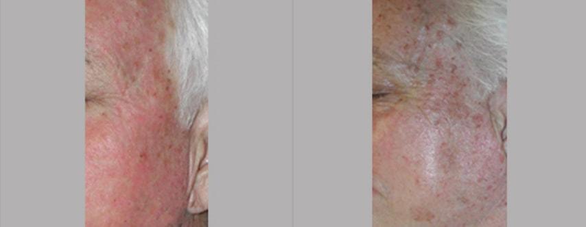 Advanced Plastic Surgery Centre laser treatment result — Spring, TX
