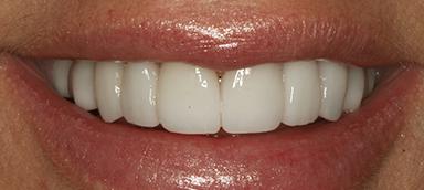 Pure Dental Health veneers after — Atlanta, GA