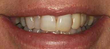 Dental Veneers before at Pure Dental Health in Atlanta, GA