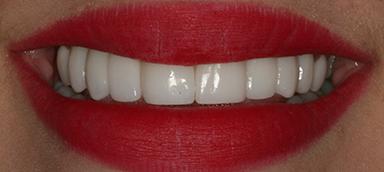 Pure Dental Health veneers after — Atlanta, GA