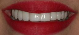Pure Dental Health dental veneers result