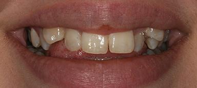 Dental Veneers before at Pure Dental Health in Atlanta, GA