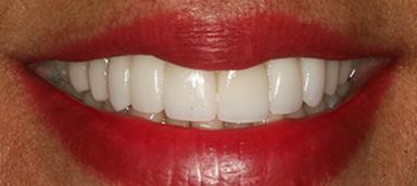Pure Dental Health veneers after — Atlanta, GA