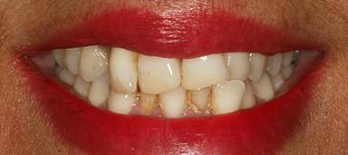 Dental Veneers before at Pure Dental Health in Atlanta, GA