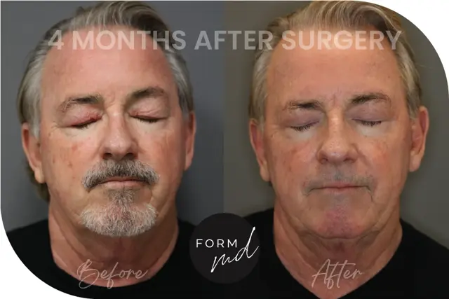 Blepharoplasty result at FormMD Plastic Surgery - Dr. Pollei in Mission Viejo, CA