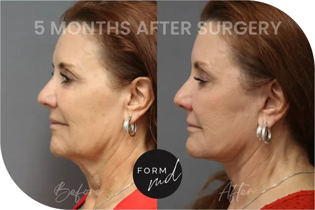 Deep Plane Facelift result at FormMD Plastic Surgery - Dr. Pollei in Mission Viejo, CA