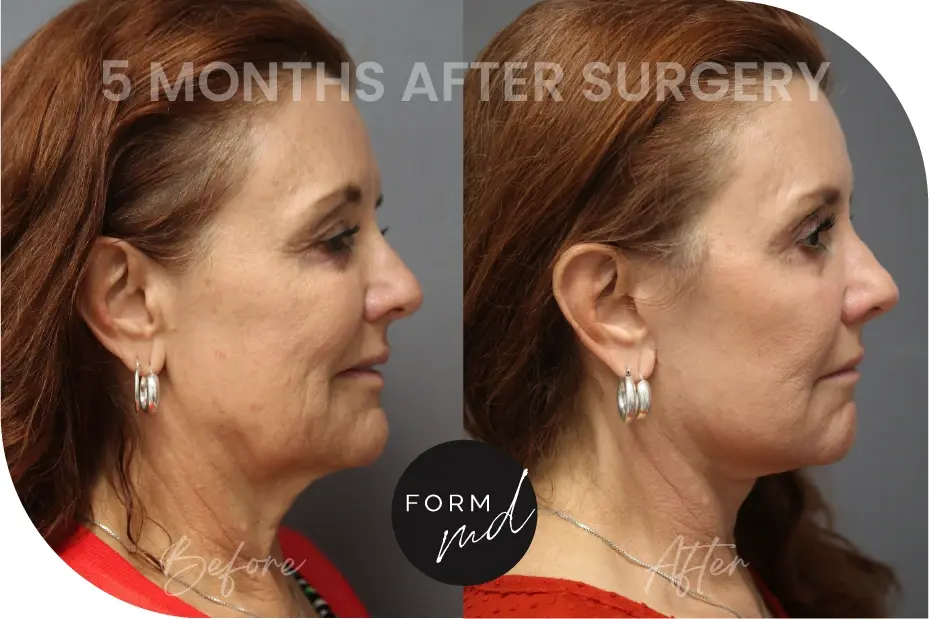 FormMD Plastic Surgery - Dr. Pollei neck lift result — Mission Viejo, CA