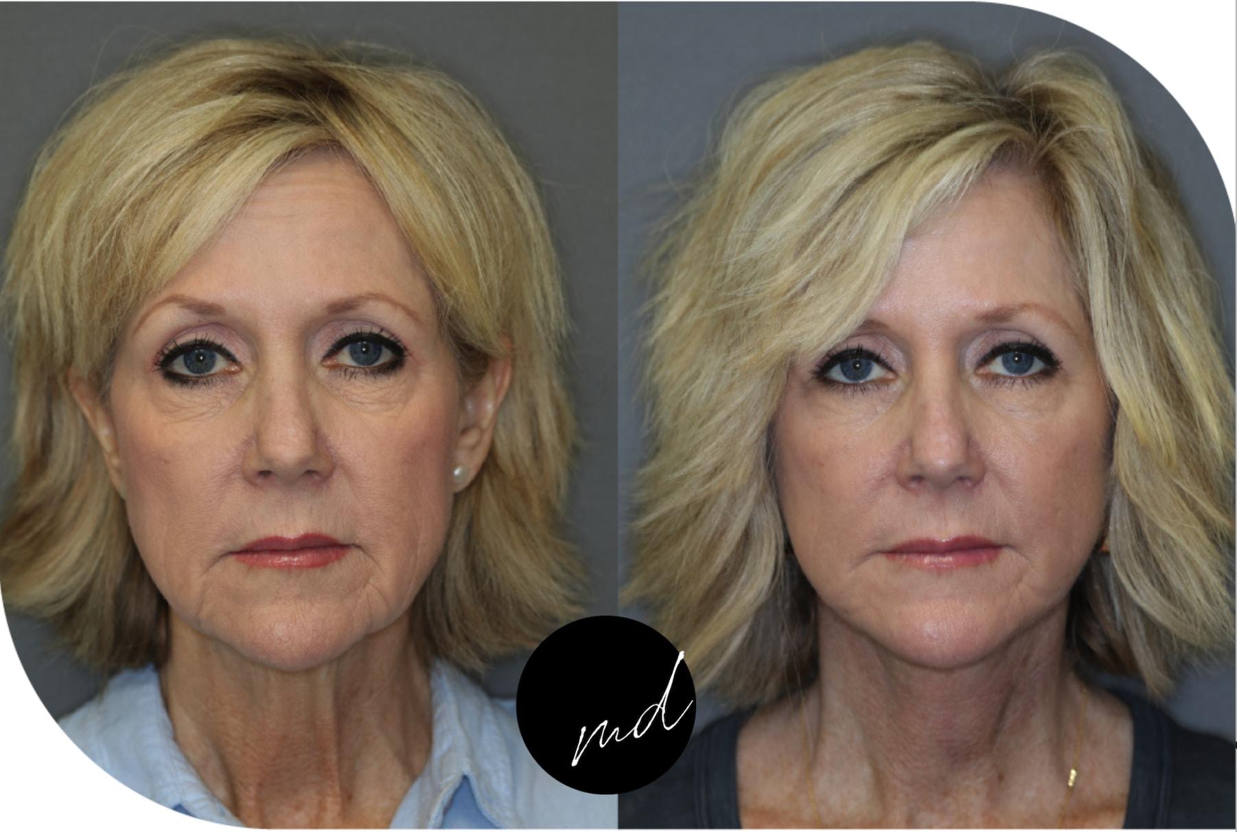 FormMD Plastic Surgery - Dr. Pollei facelift result — Mission Viejo, CA