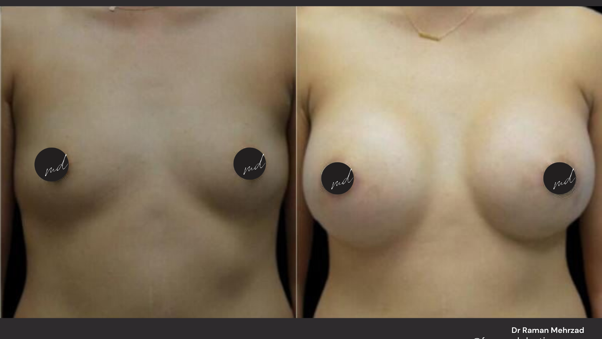 FormMD Plastic Surgery - Dr. Pollei after — Mission Viejo, CA