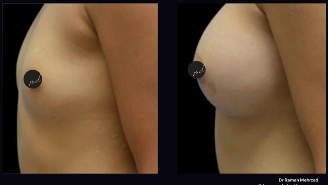 Breast Augmentation result at FormMD Plastic Surgery - Dr. Pollei in Mission Viejo, CA