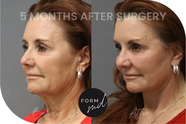 Deep Plane Facelift result at FormMD Plastic Surgery - Dr. Pollei in Mission Viejo, CA