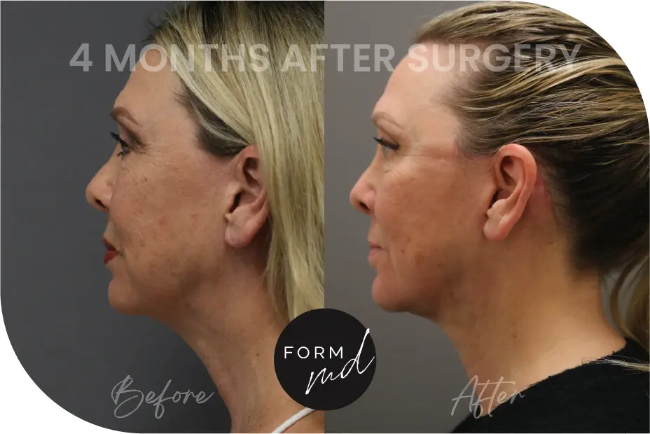 FormMD Plastic Surgery - Dr. Pollei neck lift result — Mission Viejo, CA