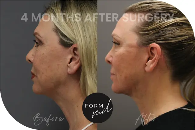 Neck Lift result at FormMD Plastic Surgery - Dr. Pollei in Mission Viejo, CA
