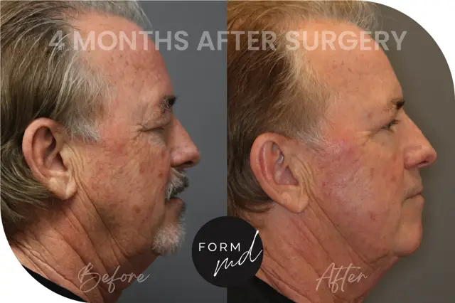 Blepharoplasty result at FormMD Plastic Surgery - Dr. Pollei in Mission Viejo, CA