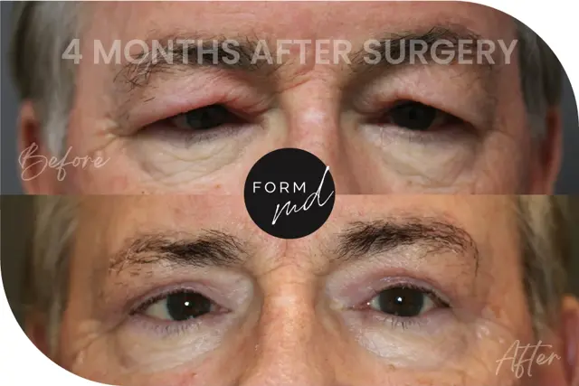 Blepharoplasty result at FormMD Plastic Surgery - Dr. Pollei in Mission Viejo, CA
