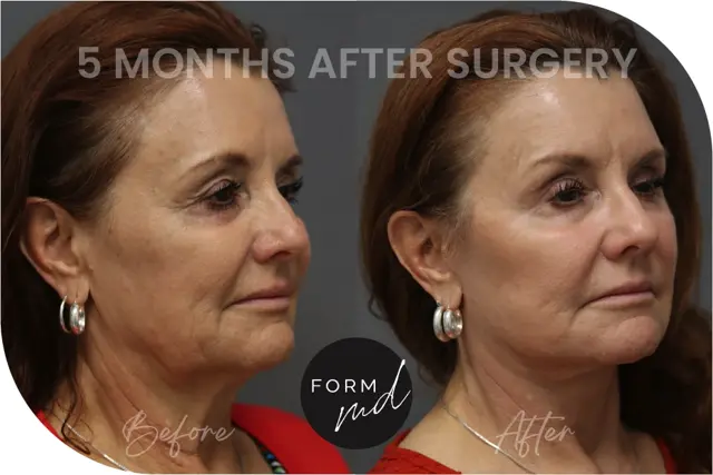 Deep Plane Facelift result at FormMD Plastic Surgery - Dr. Pollei in Mission Viejo, CA