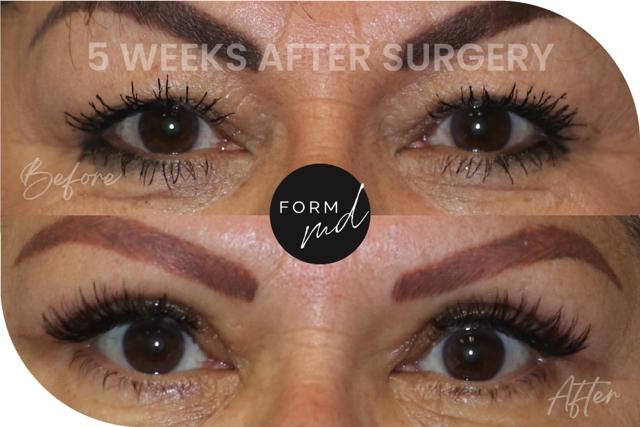 Blepharoplasty result at FormMD Plastic Surgery - Dr. Pollei in Mission Viejo, CA