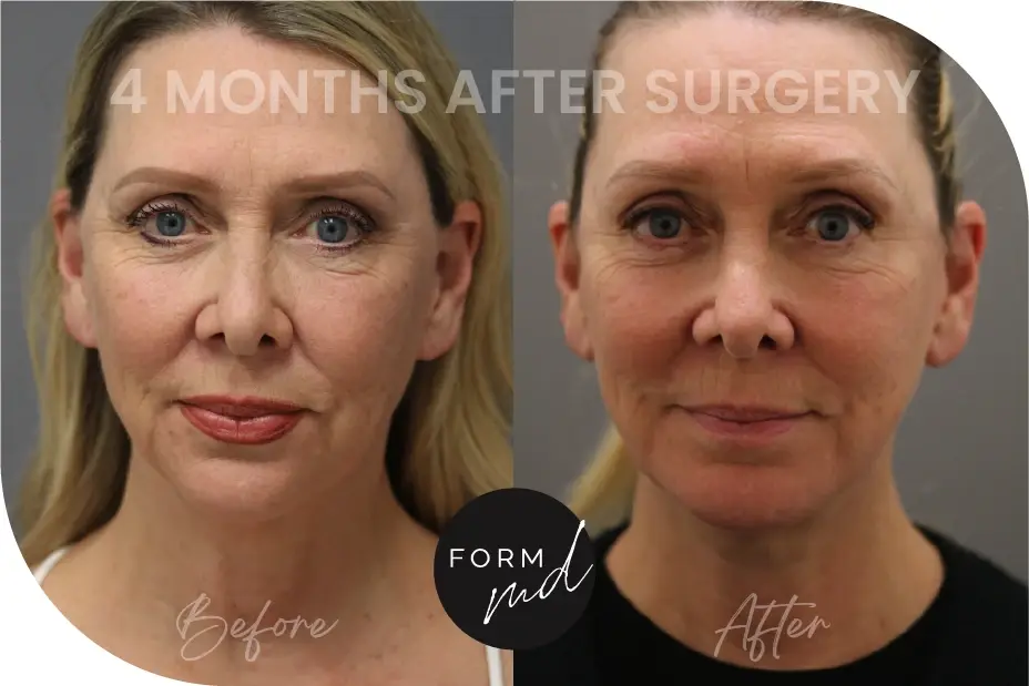 FormMD Plastic Surgery - Dr. Pollei neck lift result — Mission Viejo, CA