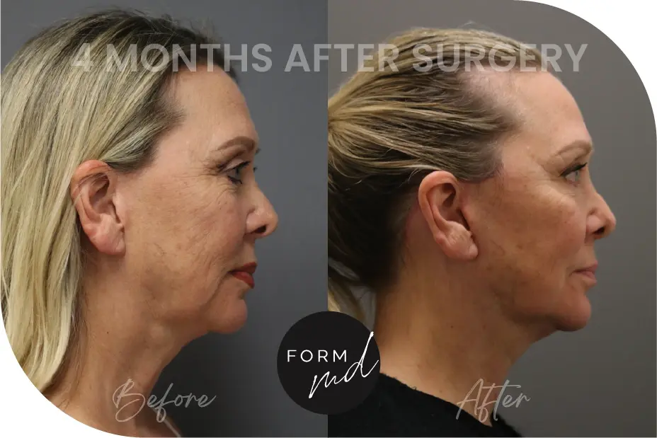 FormMD Plastic Surgery - Dr. Pollei neck lift result — Mission Viejo, CA