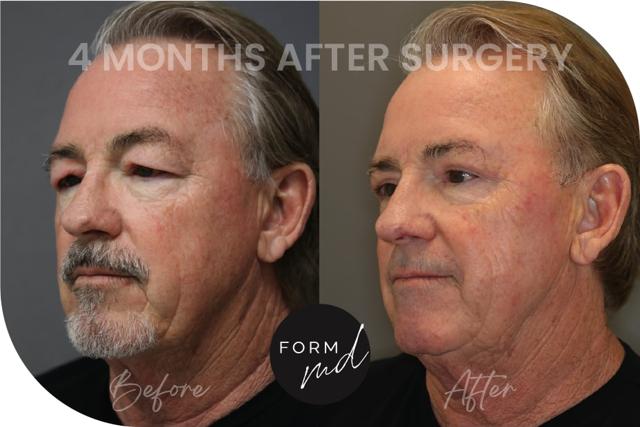 Blepharoplasty result at FormMD Plastic Surgery - Dr. Pollei in Mission Viejo, CA