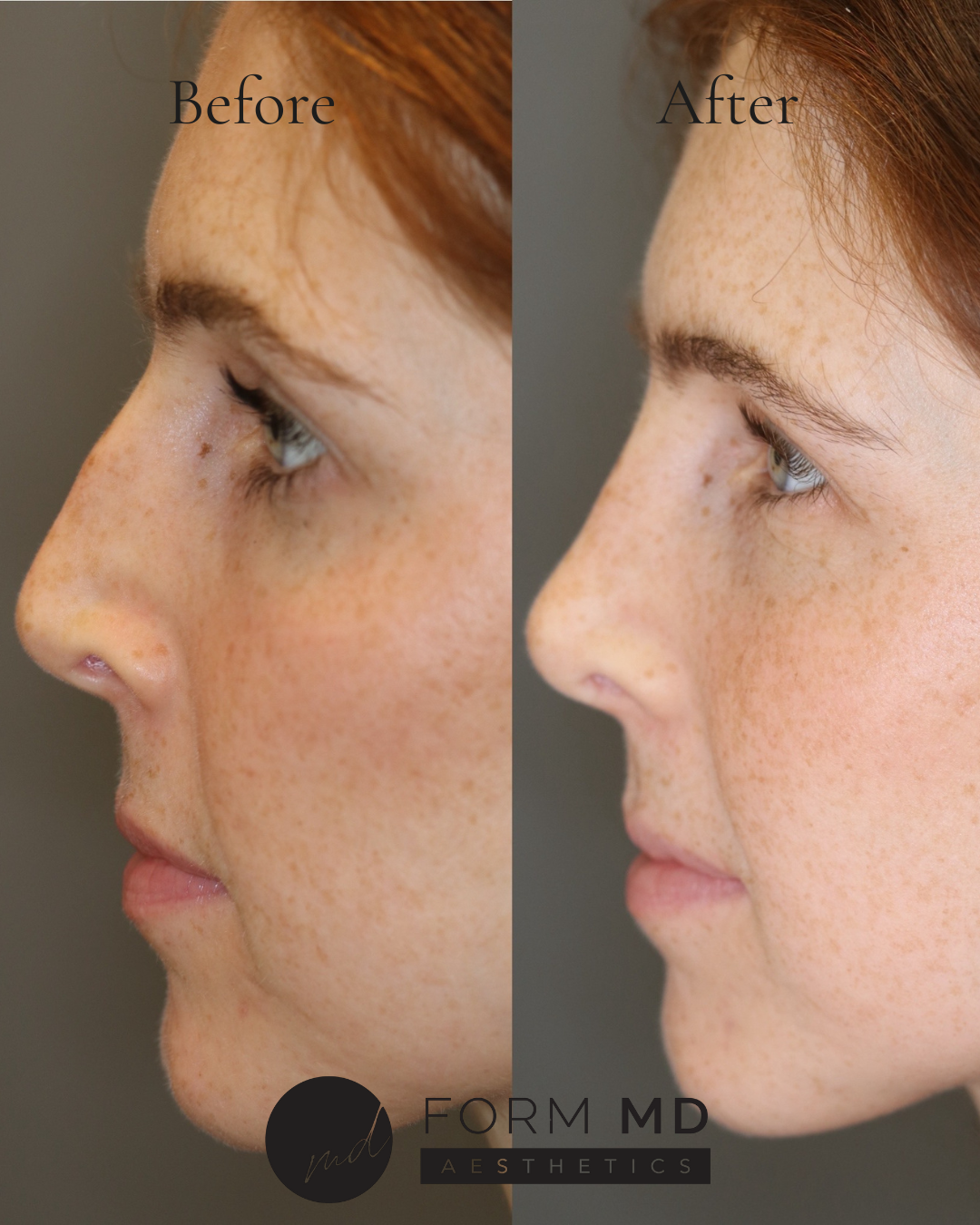 FormMD Plastic Surgery - Dr. Pollei rhinoplasty after — Mission Viejo, CA