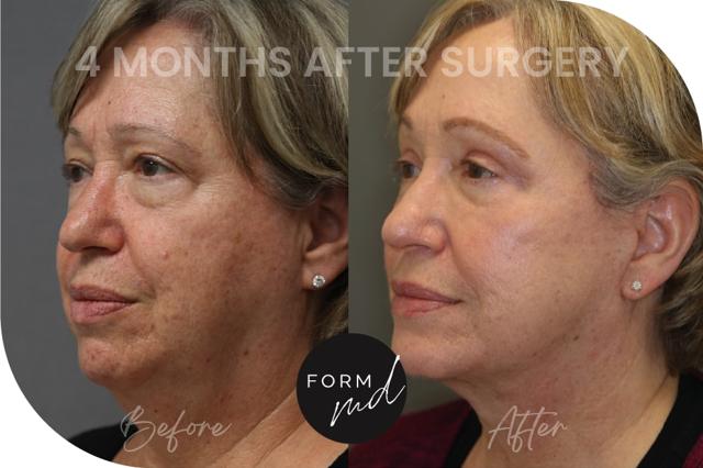 Deep Plane Facelift result at FormMD Plastic Surgery - Dr. Pollei in Mission Viejo, CA