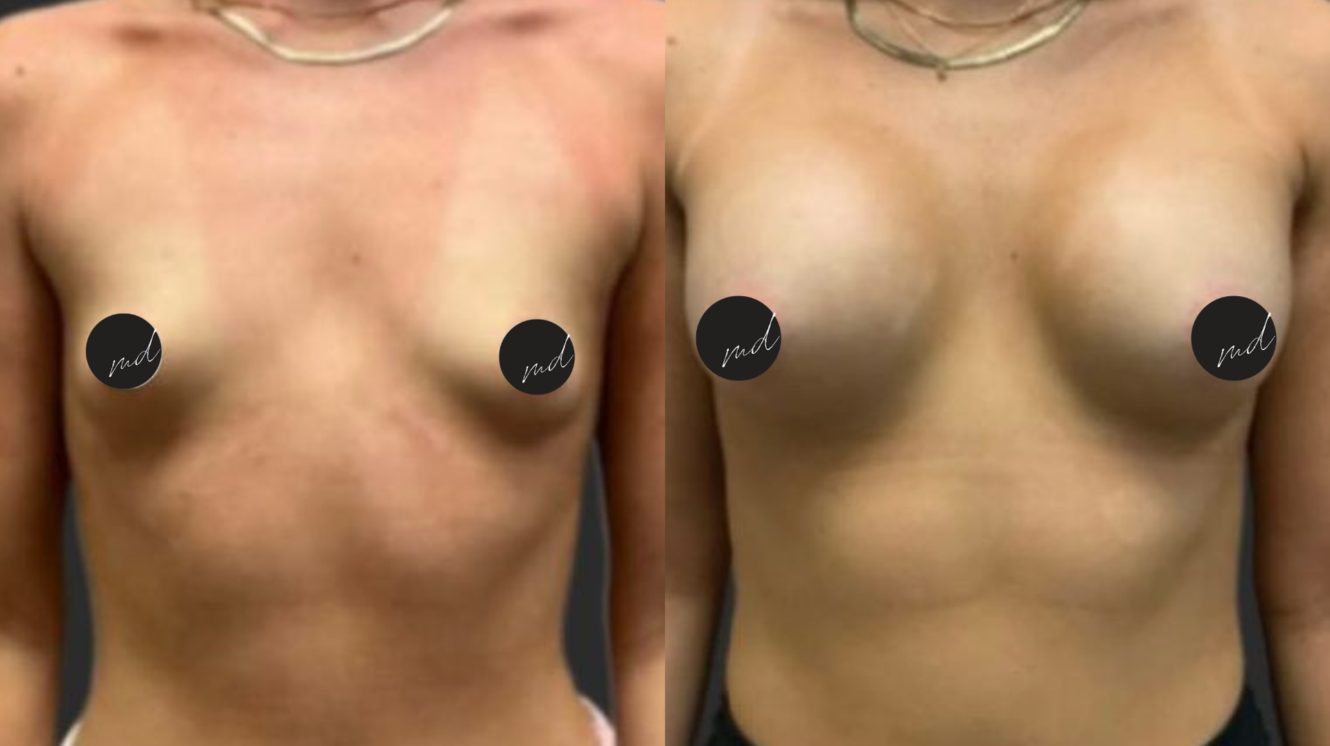 FormMD Plastic Surgery - Dr. Pollei after — Mission Viejo, CA