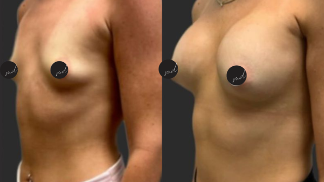 Breast Augmentation result at FormMD Plastic Surgery - Dr. Pollei in Mission Viejo, CA