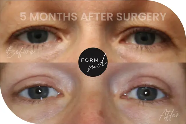 Blepharoplasty result at FormMD Plastic Surgery - Dr. Pollei in Mission Viejo, CA