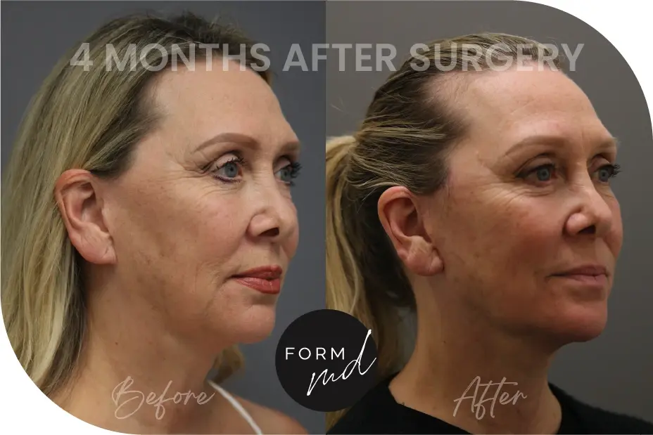 FormMD Plastic Surgery - Dr. Pollei facelift result — Mission Viejo, CA