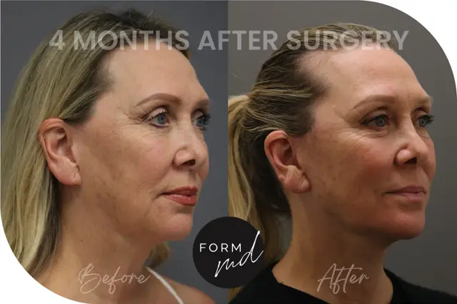 Deep Plane Facelift result at FormMD Plastic Surgery - Dr. Pollei in Mission Viejo, CA