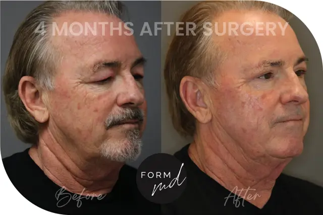 Blepharoplasty result at FormMD Plastic Surgery - Dr. Pollei in Mission Viejo, CA