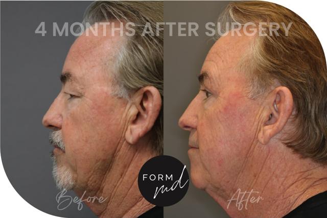 Blepharoplasty result at FormMD Plastic Surgery - Dr. Pollei in Mission Viejo, CA