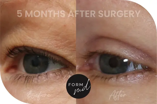Blepharoplasty result at FormMD Plastic Surgery - Dr. Pollei in Mission Viejo, CA