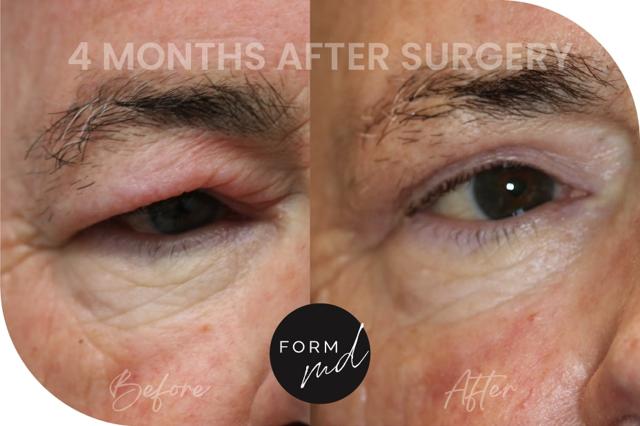 Blepharoplasty result at FormMD Plastic Surgery - Dr. Pollei in Mission Viejo, CA