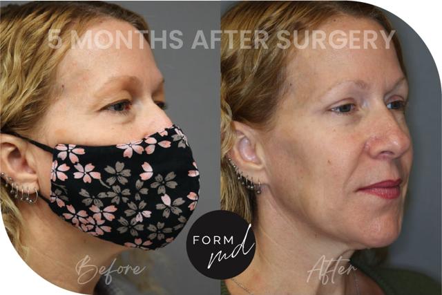Blepharoplasty result at FormMD Plastic Surgery - Dr. Pollei in Mission Viejo, CA