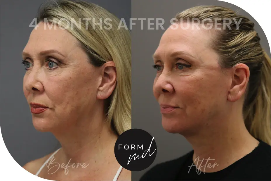 FormMD Plastic Surgery - Dr. Pollei neck lift result — Mission Viejo, CA