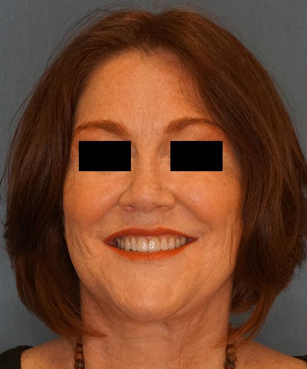 Brow Lift after at Herte Center for Cosmetic Surgery in Las Vegas, NV
