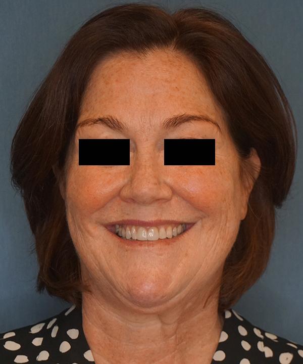 Brow Lift before at Herte Center for Cosmetic Surgery in Las Vegas, NV
