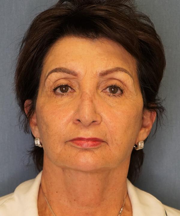Brow Lift after at Herte Center for Cosmetic Surgery in Las Vegas, NV