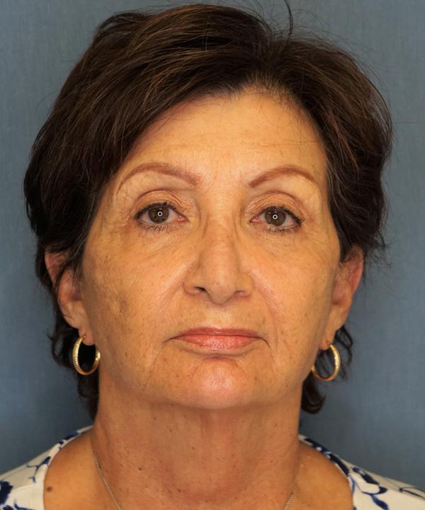 Brow Lift before at Herte Center for Cosmetic Surgery in Las Vegas, NV