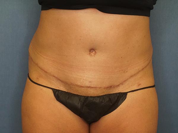 Liposuction after at Herte Center for Cosmetic Surgery in Las Vegas, NV