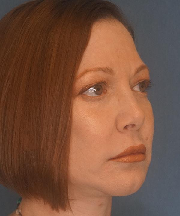 Herte Center for Cosmetic Surgery facelift after — Las Vegas, NV